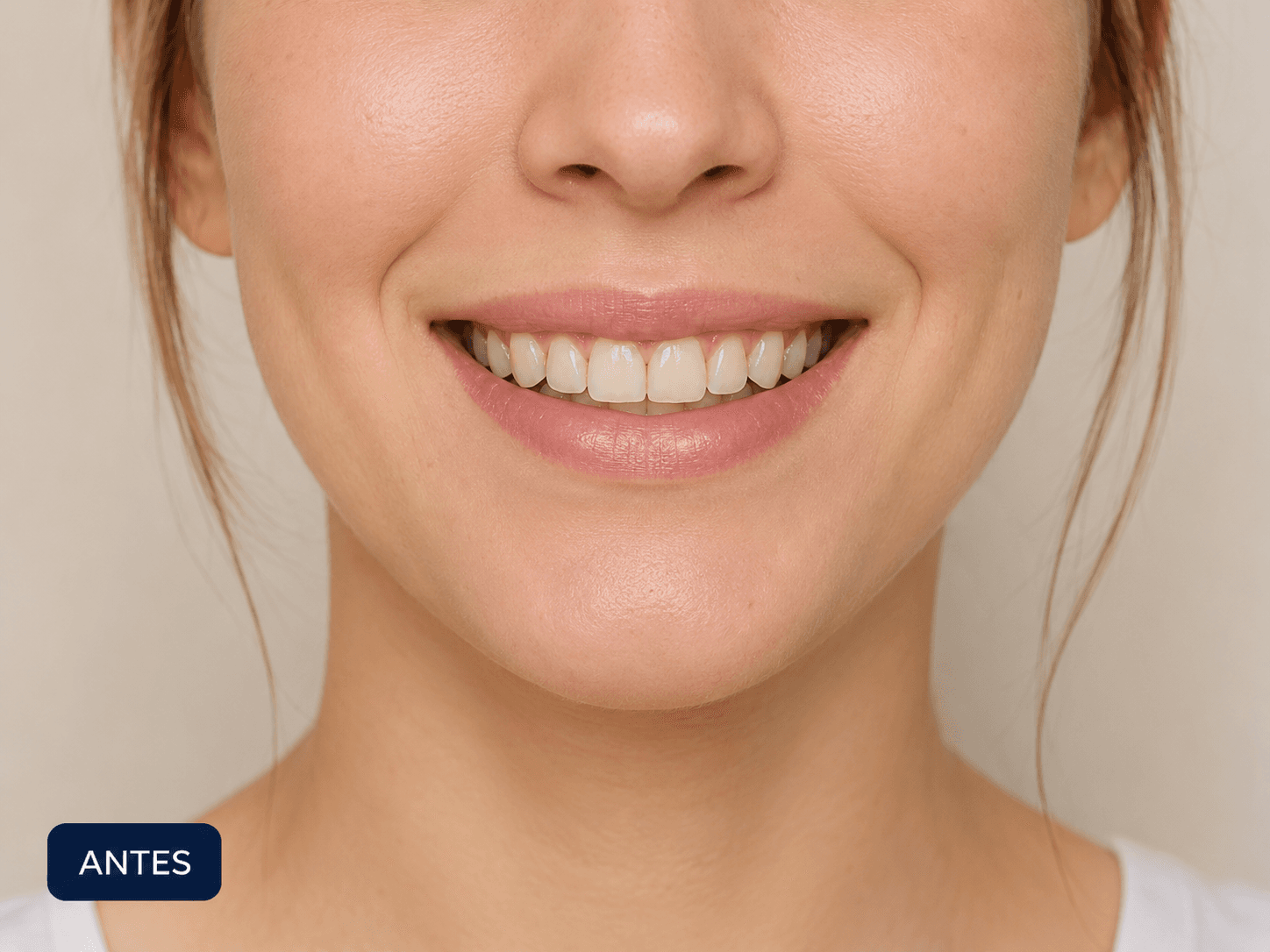 Antes del tratamiento de diseño de sonrisa