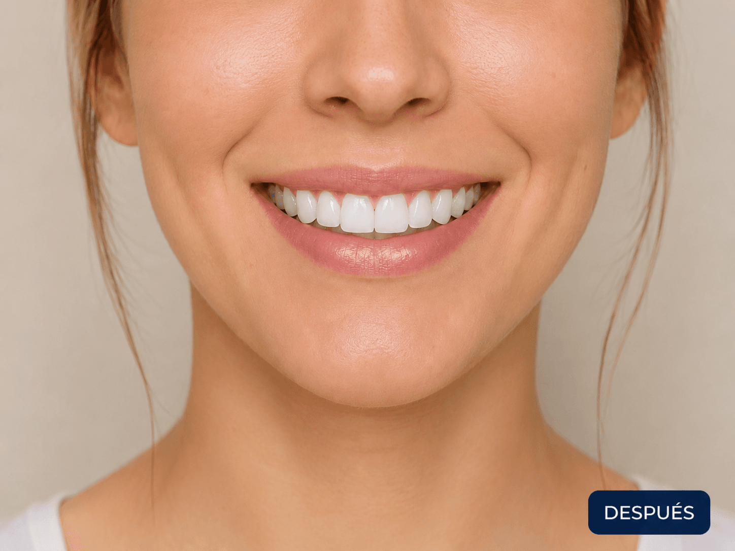Después del tratamiento de diseño de sonrisa